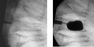 lumbar xrays showing fracture for kyphoplasty